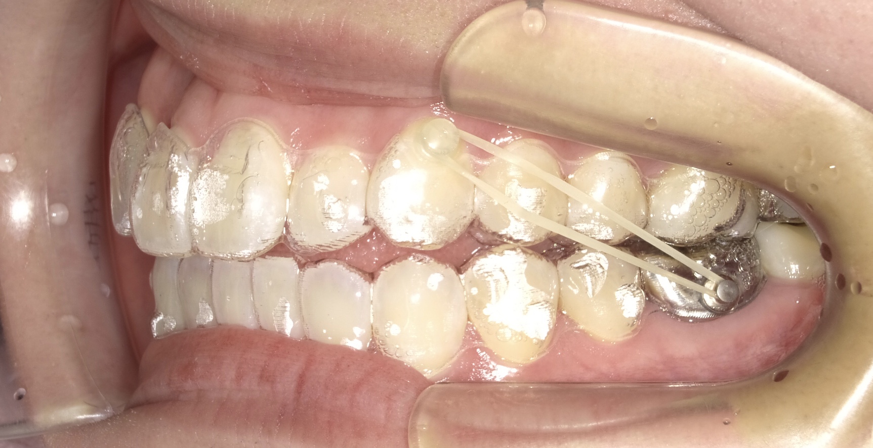 SALE／85%OFF】 歯科矯正 顎間ゴム ゴムかけ 歯並び エラスティック ワイヤー インビザライン