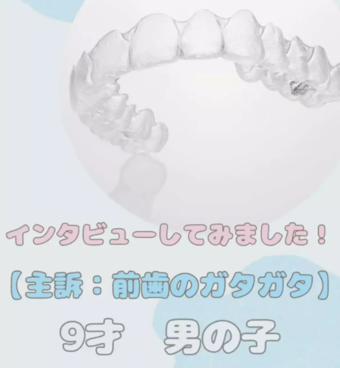 インビザライン感想